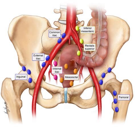 Internal Iliac Lymph Nodes