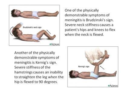 Meningitis signs: Brudzinski's sign & Kernig's Sign | Nursing stuff ...