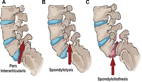 How To Cure Lumbar Spondylosis - Apartmentairline8