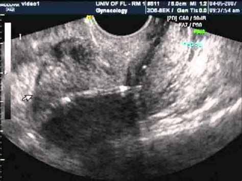 Ultrasound for Mirena Contraception - YouTube