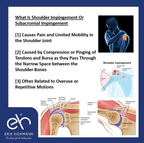 What Is Shoulder Impingement Or Subacromial Impingement Burjeel – Modafinil24