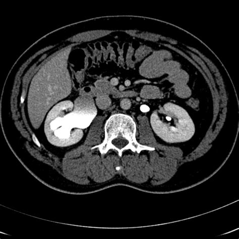 Laparoscopic Robotic Pyeloplasty » Department of Urology » College of Medicine » University of ...