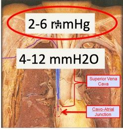 Online Central Venous Pressure (CVP) Course | IvyLeagueNurse