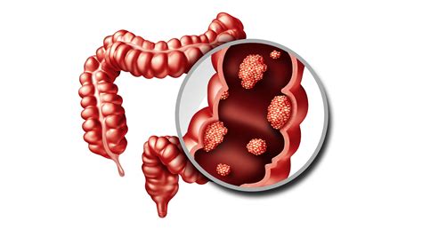 Two new studies reveal universal gut microbiome signatures in colorectal cancer