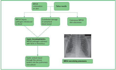 MRSA Necrotizing Pneumonia and Peripheral Septic Thrombophlebitis ...