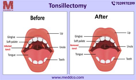 Before And After Tonsillectomy