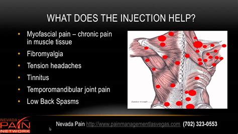 Trigger Point Injections explained by a Las Vegas pain management center - YouTube