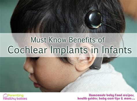 Must know Benefits of Cochlear Implants in Infants