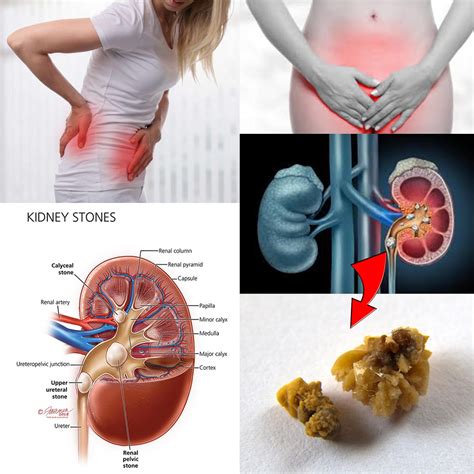 Kidney Stone Size In Mm