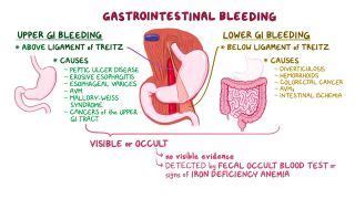 Esophageal Varices: What Are They, Causes, and More | Osmosis