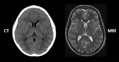 #61 - Rajpaul Attariwala, M.D., Ph.D.: Cancer screening with full-body MRI scans and a seminar ...