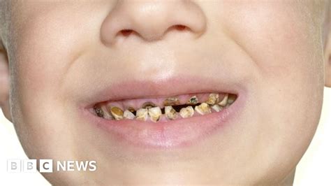 Child tooth removal 'at crisis point', doctors warn - BBC News