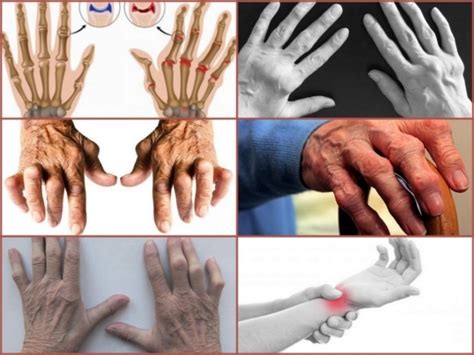 Seropositive rheumatoid arthritis: causes, symptoms, treatment