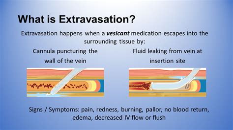 Iv Infiltration Signs