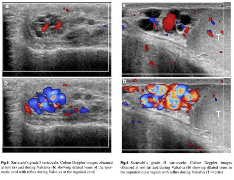 EVALUASI VARICOCELE ULTRASOUND – radiologi.id