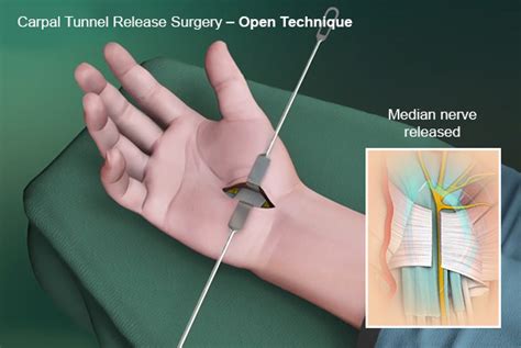 Median Nerve Perth | Carpal Tunnel Release Surgery Nedlands