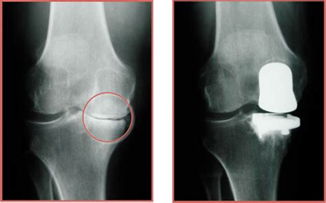 Dr. Craig J. Della Valle, Hip and Knee surgeon Partial Knee Replacement - Dr. Craig J. Della ...