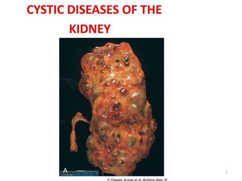What Causes A Cyst To Form On Your Kidney - HealthyKidneyClub.com
