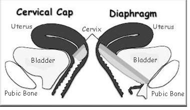 Images – Cervical Barrier Advancement Society