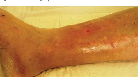 Figure 1 from Pasteurella multocida infection in a cirrhotic patient ...