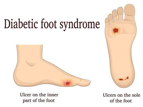 Foot Problems and Diabities | Clancy Medical Group | Vista Ca