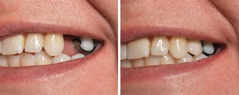 SIngle Tooth Implant - Mt. View Family Dental