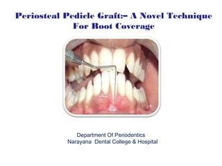 case report of Periosteal pedicle graft-novel technique | PPT