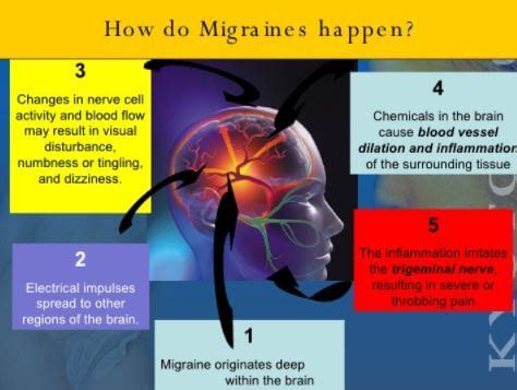 Ocular Migraine - Symptoms, Causes, What is?, Treatment, Images