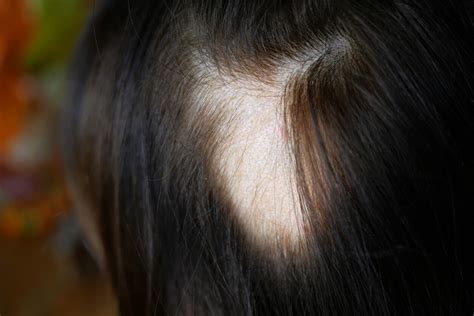 Hair Loss in Adolescence: Symptoms, Causes, and Treatment