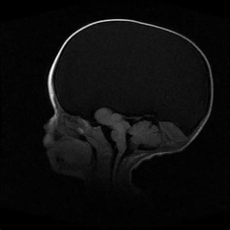 Hydranencephaly - no remaining cortical tissue, with preserved thalami ...