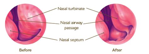 Coblation Turbinate Reduction - eos sleep