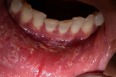 Desquamative gingivitis, definition, causes, symptoms, diagnosis & treatment