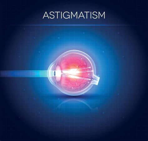 Astigmatism Illustrations, Royalty-Free Vector Graphics & Clip Art - iStock