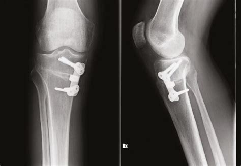 Corrective proximal tibial osteotomy in a varus knee