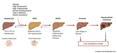 Fatty Liver Disease