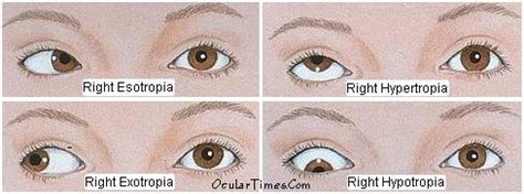 Strabismus Testing Techniques