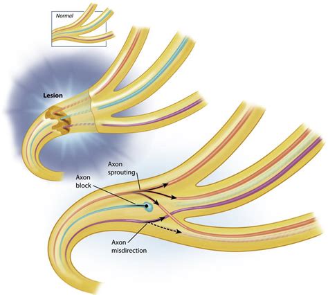 Surgical Management of Postparalysis Facial Palsy and Synkinesis ...