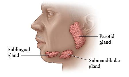 MENGENAL PAROTITIS - RS Kasih Ibu Surakarta