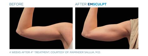 Emsculpt Muscle Toning Boston - Nonsurgical Muscle Toning