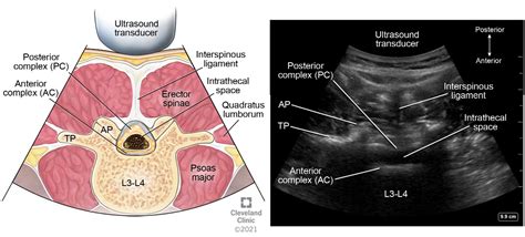 How I Do It: Neuraxial Ultrasound