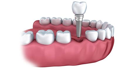 Do I Really Need a Crown? 4 Dental Crown Alternatives (2020 UPDATE)