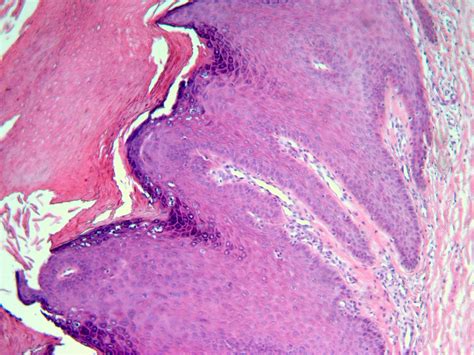 Verruca Histology