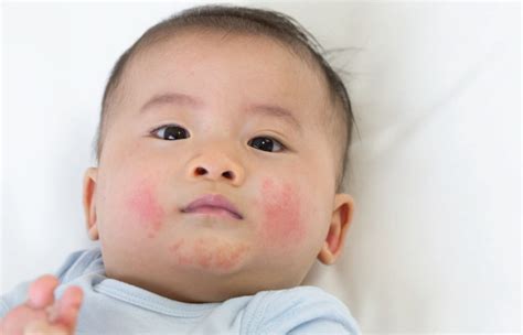 Eczema in babies and children | SBCC Baby & Child Clinic