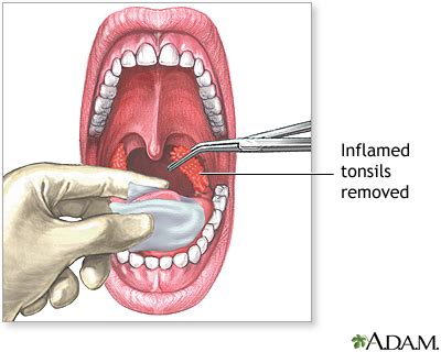 Tonsillectomy - series—Procedure: MedlinePlus Medical Encyclopedia