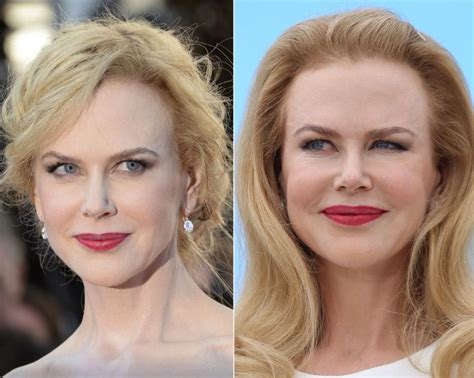 Nicole Kidman before and after plastic surgery (21) – Celebrity plastic surgery online