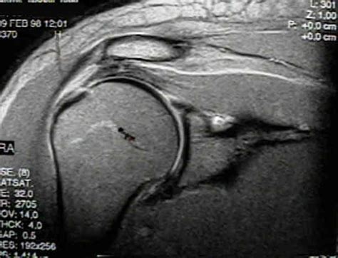 MRI Shoulder: Coronal Oblique Imaging: Wheeless' Textbook of Orthopaedics