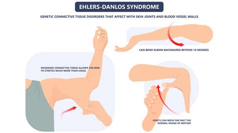 Benign Joint Hypermobility Syndrome: Evaluation, Diagnosis,, 47% OFF