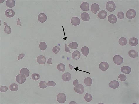 Disseminated Intravascular Coagulation (DIC) - Hematology - Medbullets Step 1