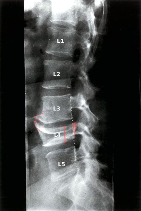 L1 Vertebrae Fracture - Post Accident Spinal Fractures With Fusion Procedure Doctor Stock