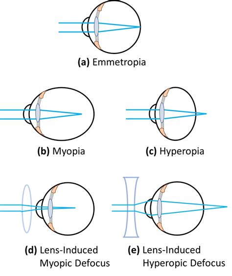 The Science Behind Myopia - Webvision - NCBI Bookshelf